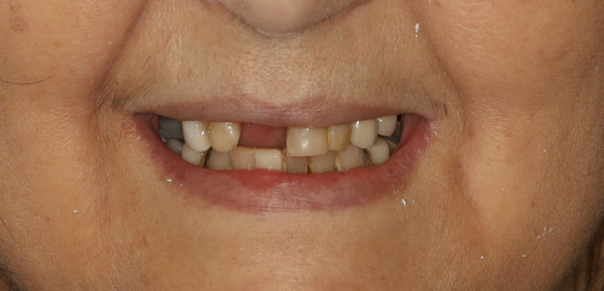 All on 4 dental treatment before picture. Woman smiling with missing and discoloured teeth,